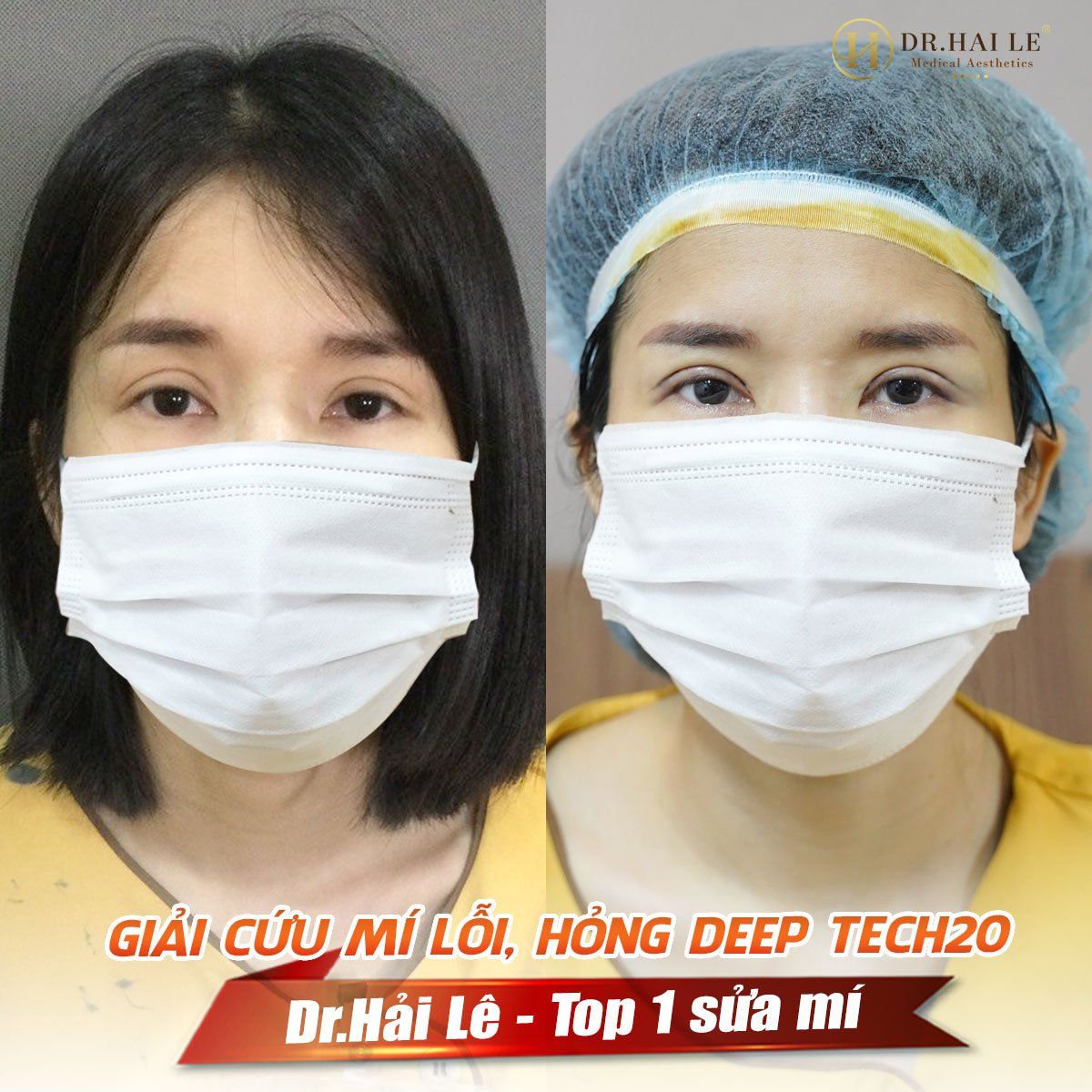 Bí quyết 360 độ không góc chết KH tự tin và không còn phải lo về khuyết điểm “xấu hỏng” đã từng phẫu thuật tại cơ sở thiếu uy tín!