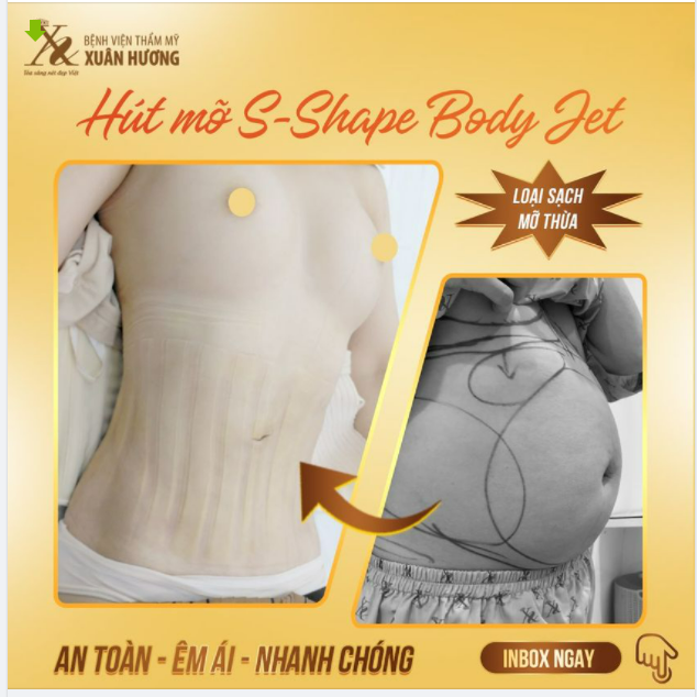 BỤNG GỌN GÀNG - CƠ THỂ "NHẸ NHÀNG" SAU 60 PHÚT HÚT MỠ BỤNG NỘI SOI S-SHAPE BODY JET TẠI BVTM XUÂN HƯƠNG