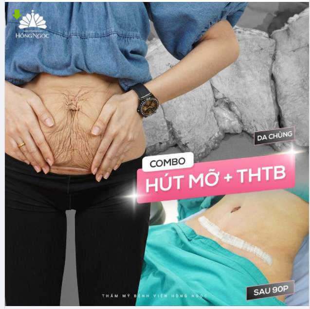 BỤNG GỌN - NHƯ THUỞ CÒN SON VỚI COMBO HÚT MỠ VASER LIPO + THTB
