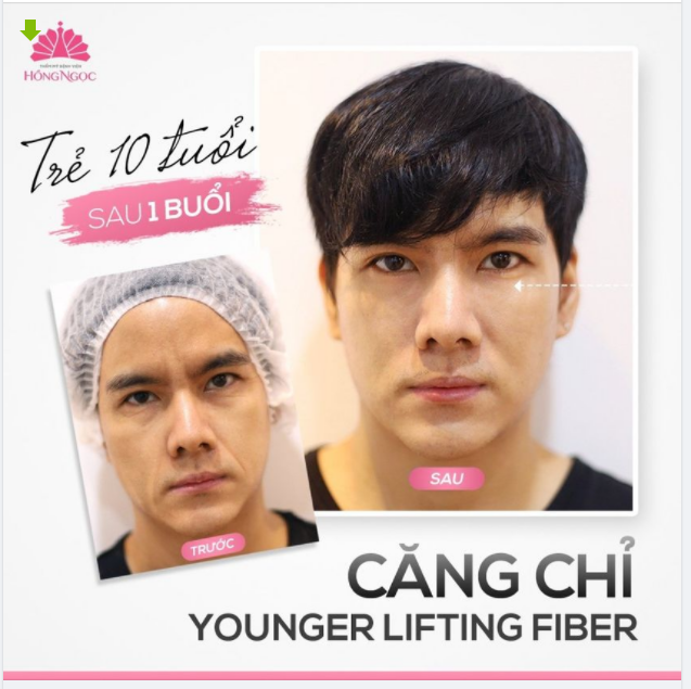 CẬN CẢNH KHUÔN MẶT TRẺ HƠN TUỔI THẬT CỦA ANH THÁI SAU 60 PHÚT CĂNG CHỈ YFL