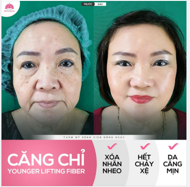 CĂNG CHỈ TOÀN MẶT YLF CHỈ 25TR