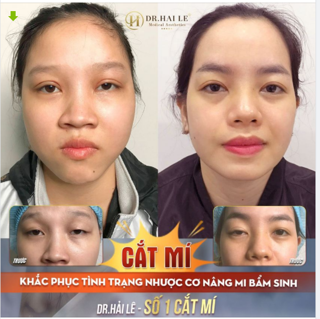 CẮT MÍ - KHẮC PHỤC NHƯỢC CƠ NÂNG MI BẨM SINH DR.HẢI LÊ - SỐ 1 CẮT MÍ.!