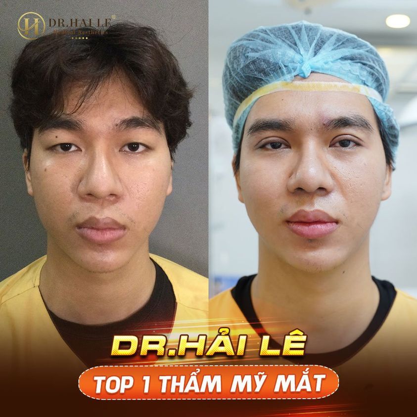 Cắt mí khó cho nam giới - Dr.Hải Lê top 1 thẩm mỹ mắt.!