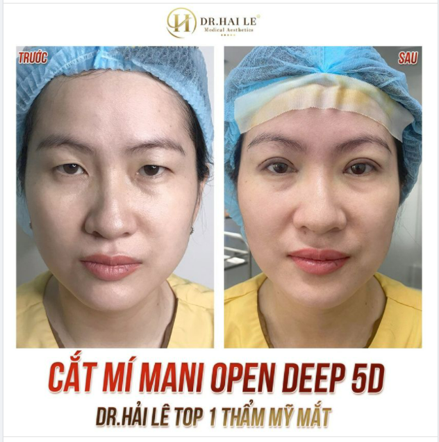 CẮT MÍ MANI OPEN DEEP 5D - DR.HẢI LÊ TOP 1 THẨM MỸ MẮT.!!