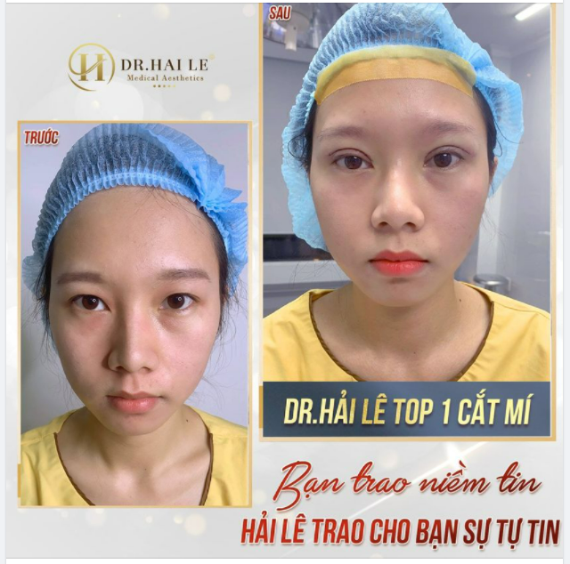 CẮT MÍ NHỮNG ĐIỀU CẦN BIẾT?