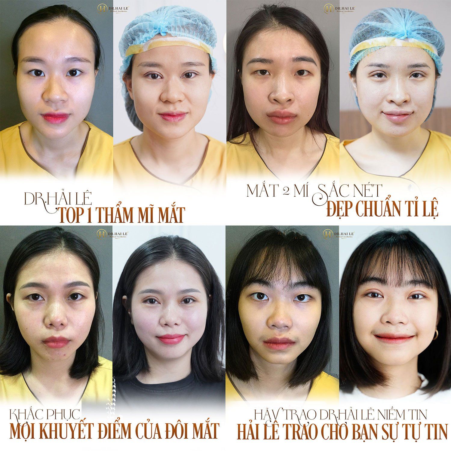 CẮT MÍ THẨM MỸ DR.HẢI LÊ - MỘT TIỂU PHẪU NHỎ, MỘT THAY ĐỔI LỚN