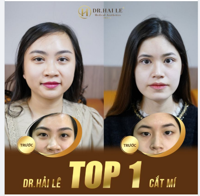 CẮT MÍ THẨM MỸ - DR.HẢI LÊ TOP 1 THẨM MỸ MẮT.!