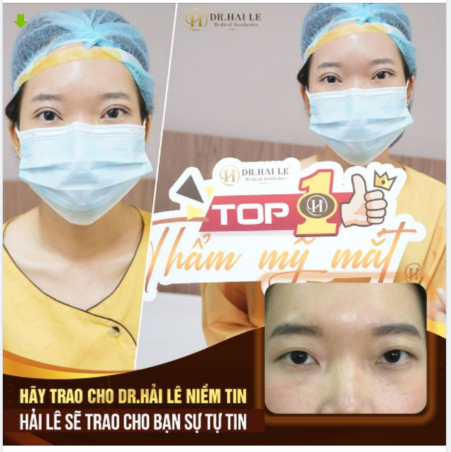 CẮT MÍ THẨM MỸ - MỘT TIỂU PHẪU NHỎ, MỘT THAY ĐỔI LỚN!