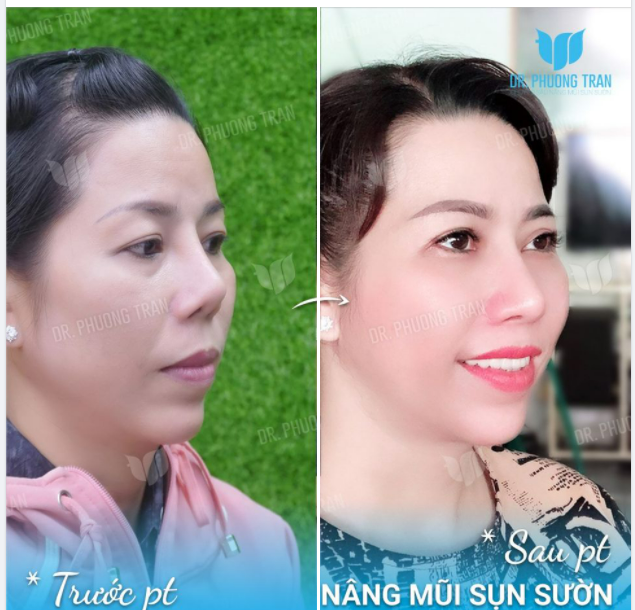 CÂU CHUYỆN MỚI CỦA MỘT GÓC NGHIÊNG