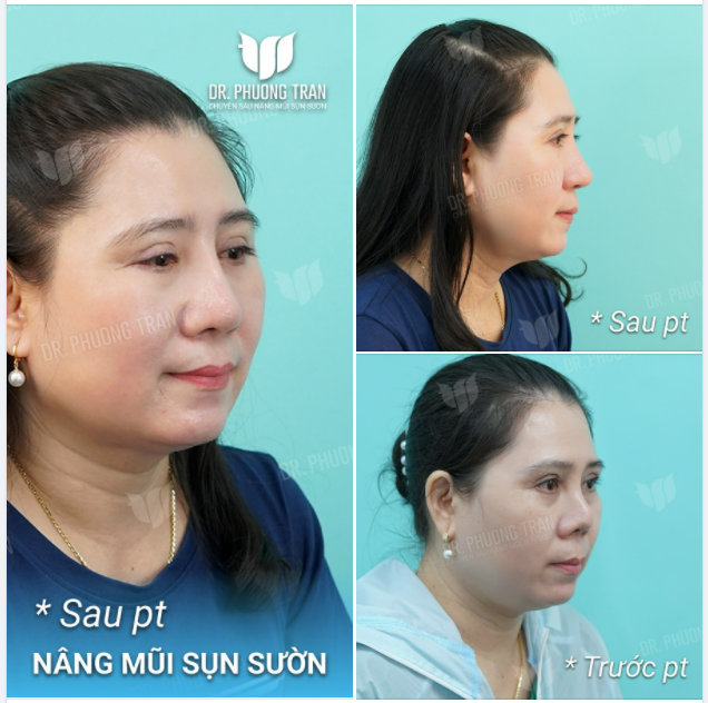 CÂU CHUYỆN MỚI VỀ CHIẾC MŨI CO RÚT NẶNG