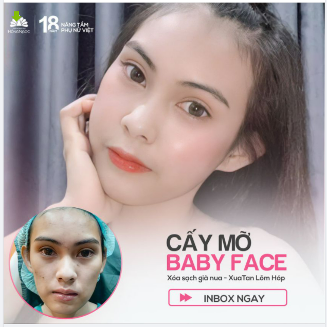 CẤY MỠ BABY FACE TẠI HỒNG NGỌC CÓ ''TRẺ'' NHƯ LỜI ĐỒN