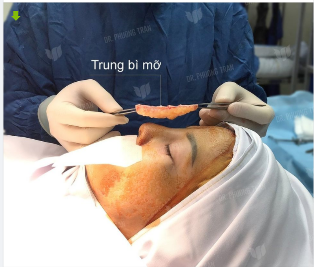 CẤY TRUNG BÌ MỠ MÔNG VÀO MŨI