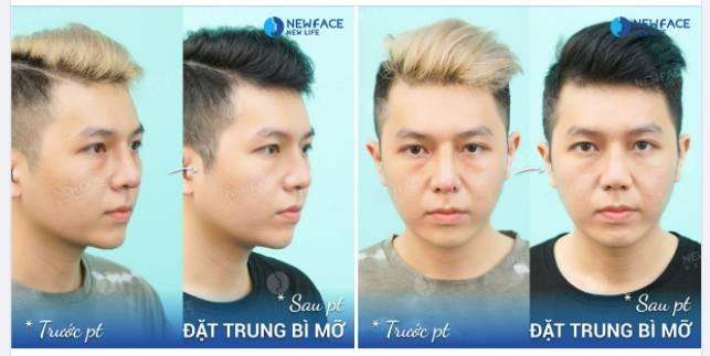 Cấy trung bì mỡ sau khi tháo sụn do sưng viêm.