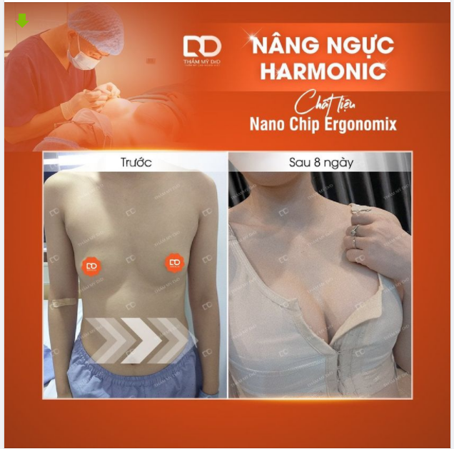 Chỉ 60 phút bạn đã có ngay một "tâm hồn" đẹp. 5 lý do đặc biệt khiến bạn lựa chọn Nâng V1 Harmonic ngay
