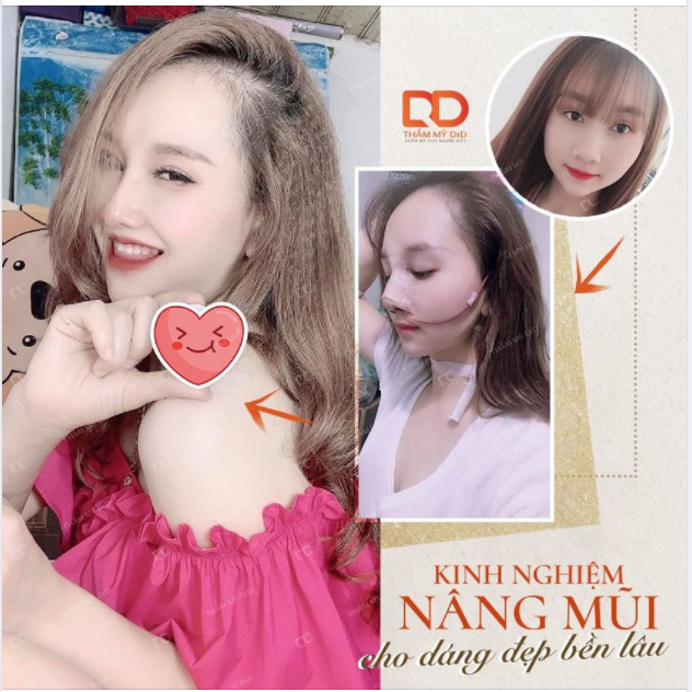 Chia sẻ với nàng một chút kinh nghiệm khi có dự định thực hiện Nâng mũi mà DrD cho rằng luôn đúng trong mọi trường hợp.