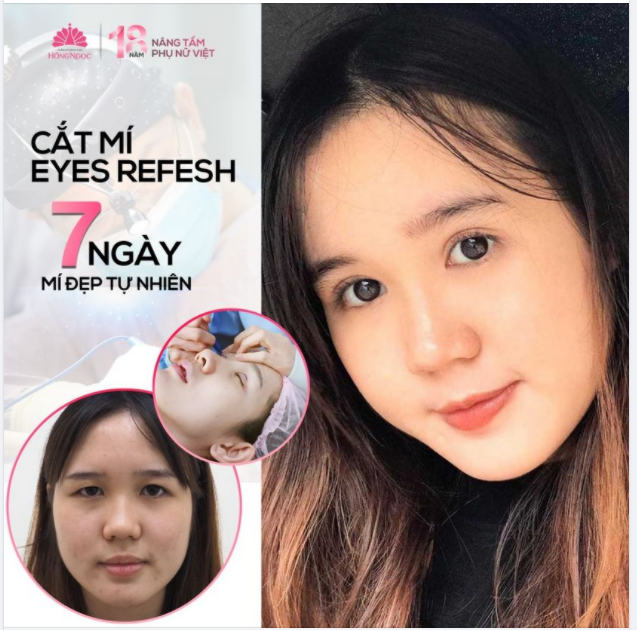 CHIA TAY MẮT 1 MÍ, DA CHÙNG MỠ THỪA SỞ HỮU MẮT 2 MÍ SẮC NÉT VỚI CẮT MÍ EYES REFESH: