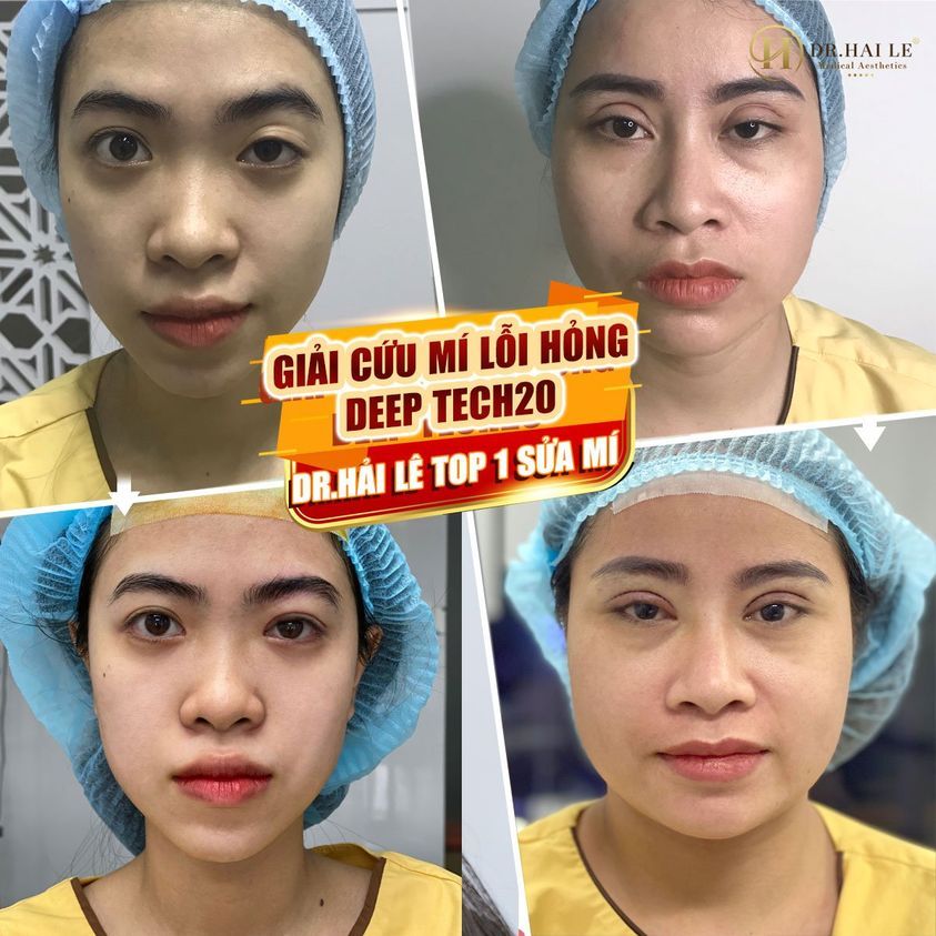 CHIÊM NGƯỠNG KẾT QUẢ SAU SỬA MÍ TẠI DR.HẢI LÊ NGAY SAU KHI THỰC HIỆN
