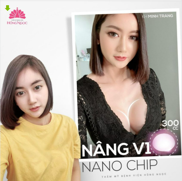 Cô nàng Hà Anh lựa chọn nâng cấp V1 Dual Plane tại Hồng Ngọc.
