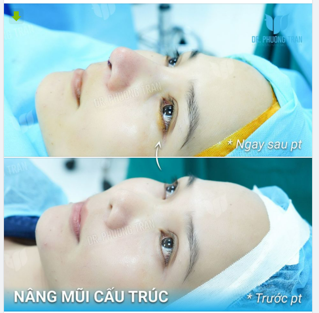 CÓ RẤT NHIỀU SỰ XINH ĐẸP TRONG CA MŨI NÀY