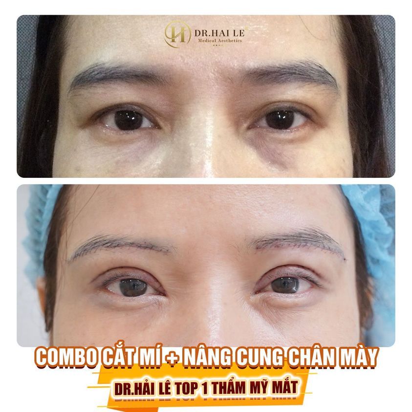 Combo Cắt mí Nâng cung mày - Dr.Hải Lê top 1 thẩm mỹ mắt.!