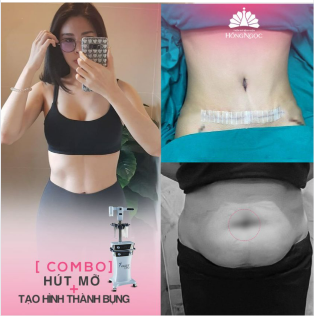 COMBO HÚT MỠ TẠO HÌNH THÀNH BỤNG - ''CỨU TINH'' CHO V2 QUÁ KHỔ