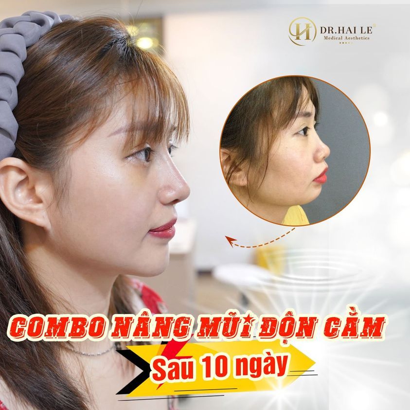Combo Nâng mũi Độn cằm 10 ngày xuất sắc tại Dr.Hải Lê