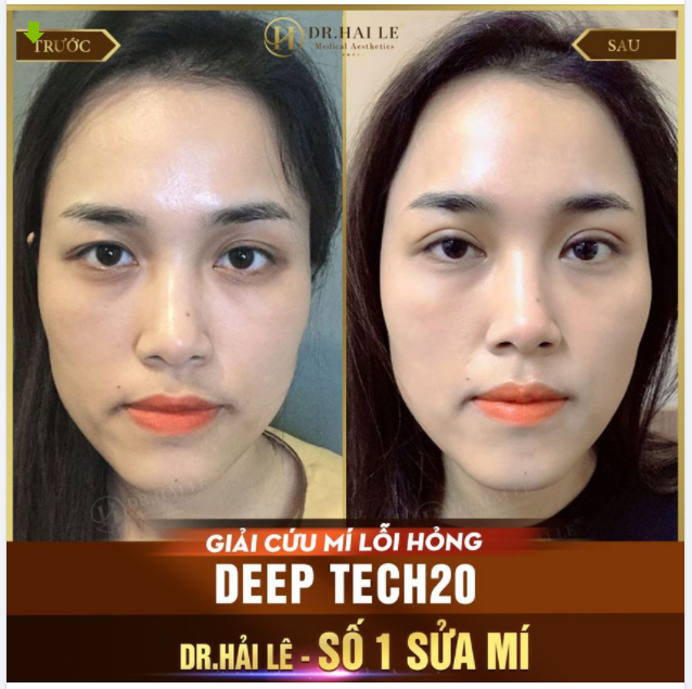 ĐÃ TỪNG NHẤN MÍ THÌ CÓ THỰC HIỆN CẮT MÍ ĐƯỢC NỮA KHÔNG