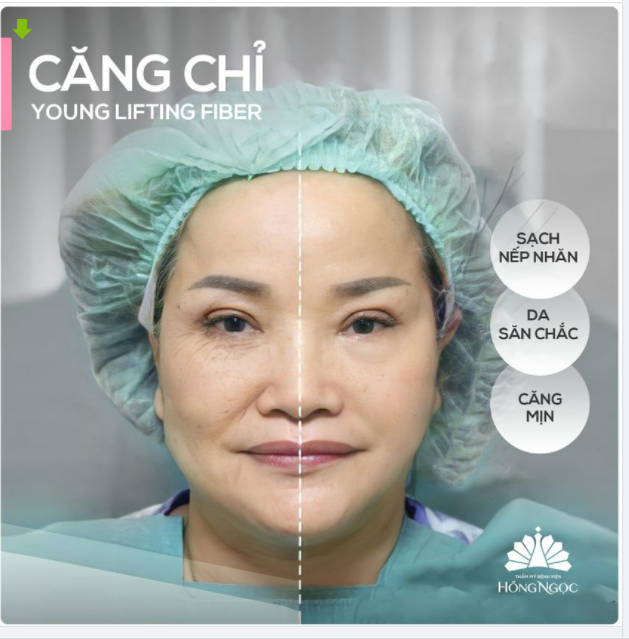ĐÁNH BAY NẾP NHĂN 1/2 GƯƠNG MẶT SAU 30P CĂNG CHỈ TRẺ HOÁ, U60 TRẦM TRỒ VÌ QUÁ KHÁC BIỆT.