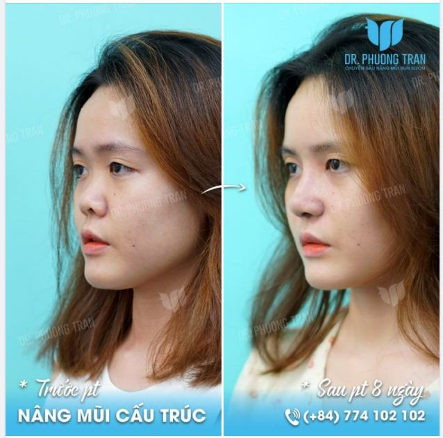 Đầu mũi ngắn nhưng da mũi quá mỏng như thế này, Tôi khuyên các bạn chỉ nên nâng mũi với độ cao tự nhiên nhất có thể.