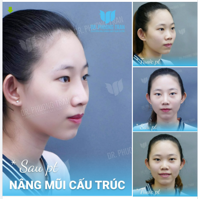 DẬY THÌ THÀNH CÔNG NHỜ NÂNG MŨI CẤU TRÚC