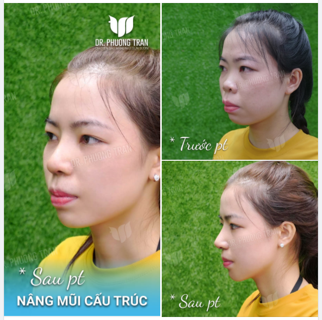 DẬY THÌ THÀNH CÔNG SAU NÂNG MŨI CẤU TRÚC