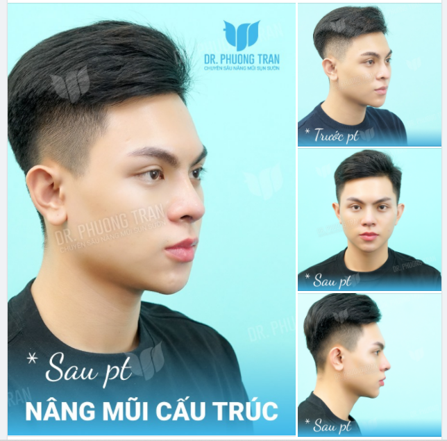 ĐẸP CHUẨN “HOTBOY” NHỜ NÂNG MŨI CẤU TRÚC