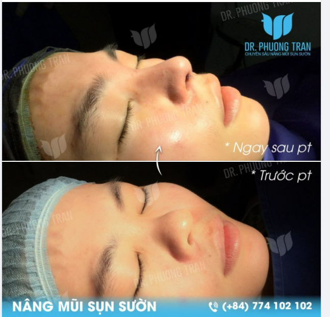 ĐẸP HƠN - BỀN HƠN VỚI NÂNG MŨI CẤU TRÚC SỤN SƯỜN