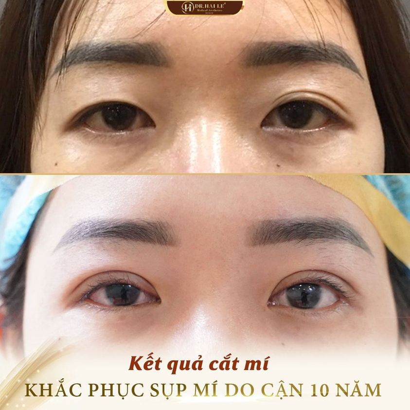 Đẹp lên “mấy chân kính” sau cắt mí trên!
