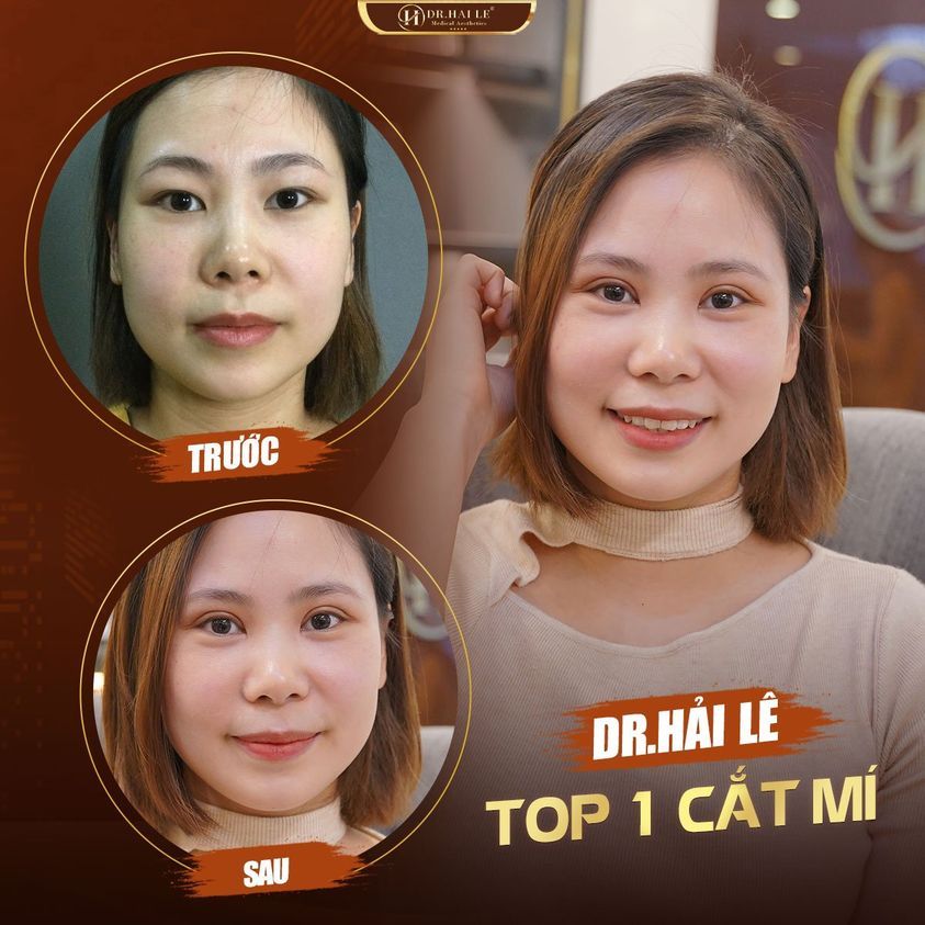 Đẹp lên “mấy chân kính” sau cắt mí trên!