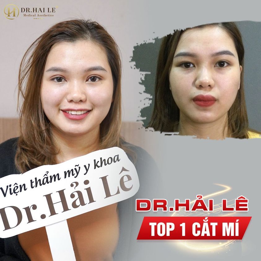 Đôi mắt đẹp của khách hàng là niềm vui của Dr.Hải Lê.!