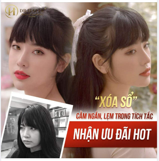 Độn cằm bao lâu sẽ hết sưng