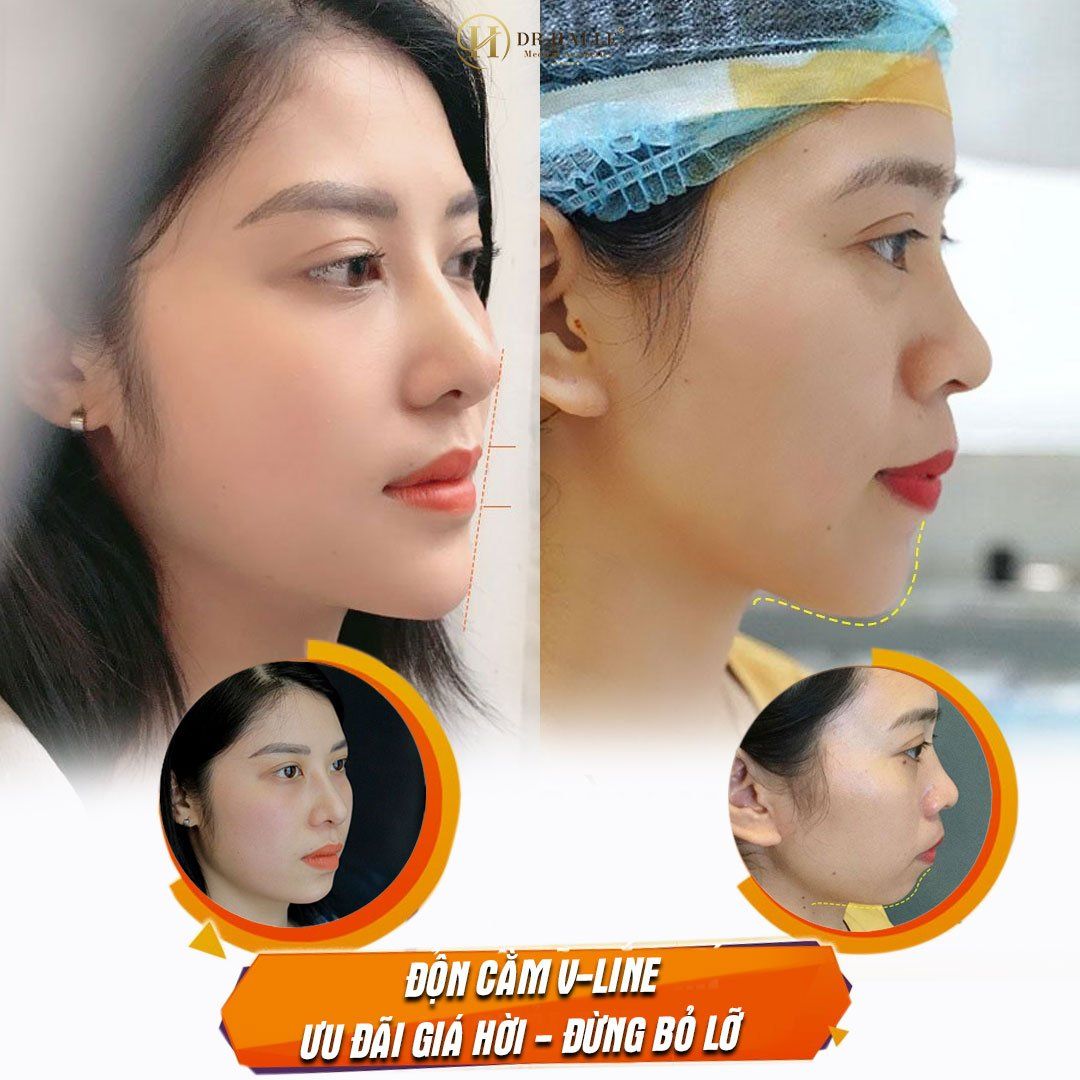 ĐỘN CẰM V-LINE - Một tiểu phẫu nhỏ, một thay đổi lớn