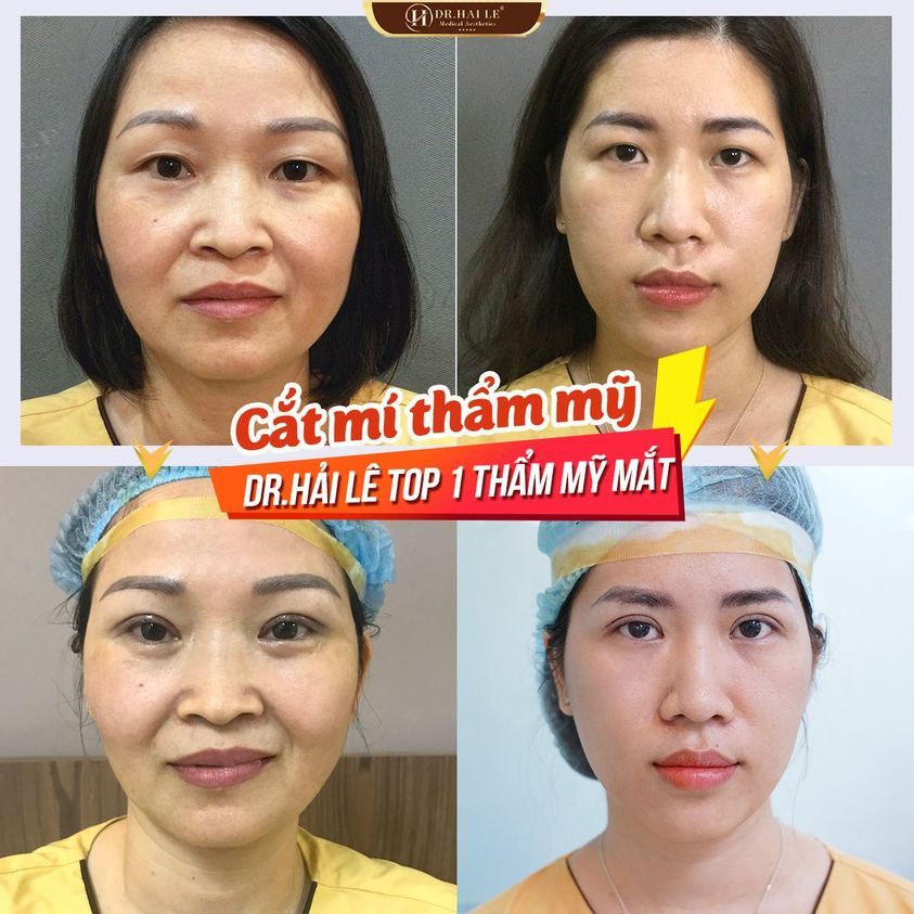 DR.HẢI LÊ - TOP 1 THẨM MỸ MẮT