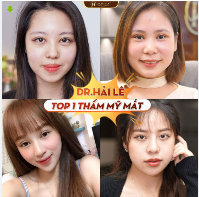 Dr.Hải Lê -Top 1 thẩm mỹ mắt