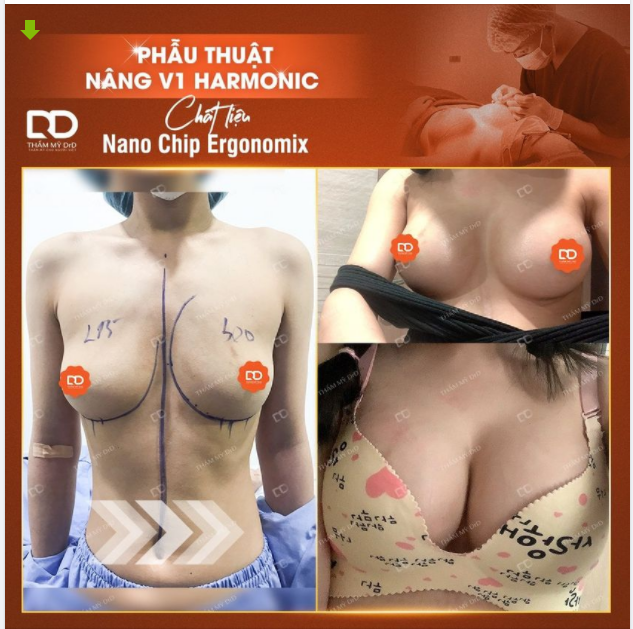 DrD mách bạn quy trình chăm sóc đơn giản sau phẫu thuật Nâng V1 để V1 luôn được tràn đầy, mềm mại.