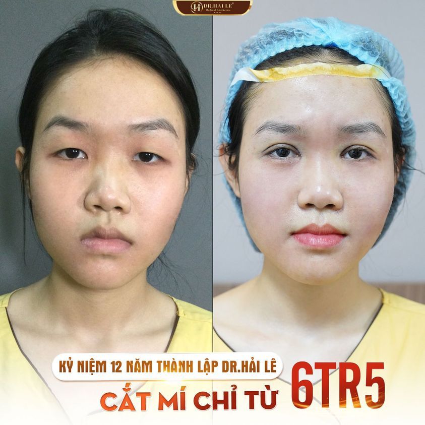 ĐỪNG CHẤP NHẬN SỐNG CHUNG VỚI MẮT 1 MÍ KÉM DUYÊN !