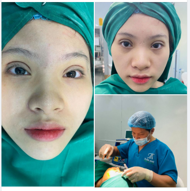 DƯỚI ĐÂY LÀ 5 SAI LẦM HÀNG ĐẦU CÓ THỂ MẮC PHẢI KHI PHẪU THUẬT CẮT MÍ / TRẺ HÓA MÍ MẮT