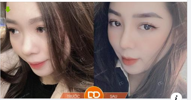 “E đã làm mũi bên bác sĩ Điền đến nay được 8 tháng rồi ạ. Chị em nào theo đuổi dáng mũi tự nhiên, không thích cao quá thì gặp bác Điền là chuẩn ạ."