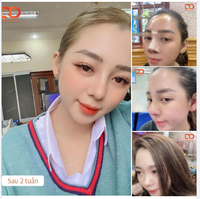“E đã làm mũi bên bác sĩ Điền đến nay được 8 tháng rồi ạ. Chị em nào theo đuổi dáng mũi tự nhiên, không thích cao quá thì gặp bác Điền là chuẩn ạ."