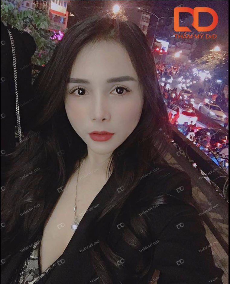 Feedback combo nâng mũi cắt mí 4 năm tuổi.