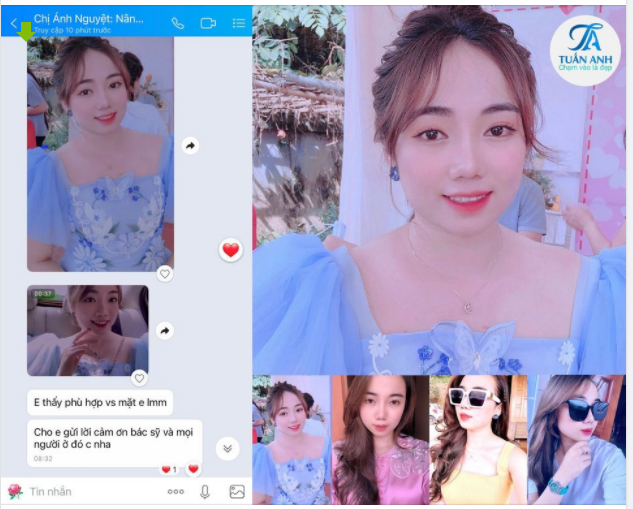 Feedback cực kì xịn sò của bạn gái xinh xắn sau khi thực hiện Combo dich vụ NÂNG MŨI BÁN CẤU TRÚC  CẮT MÍ TRÊN