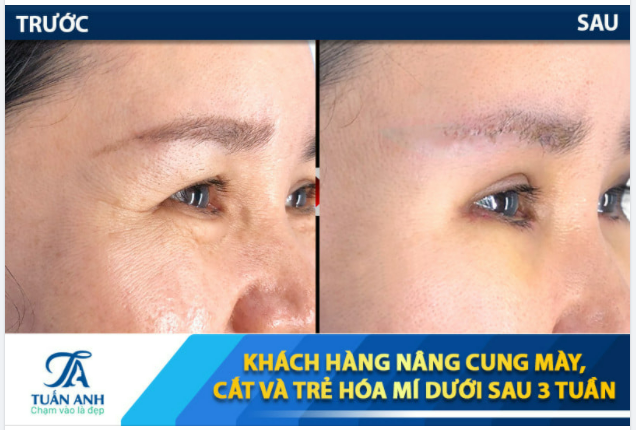 Feedback khách hàng trải nghiệm nâng cung mày 