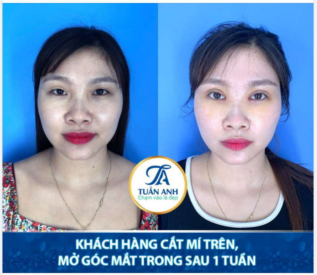 Feedback sau 1 tuần thực hiện combo cắt mí trên + mở góc mắt trong của khách hàng xinh đẹp