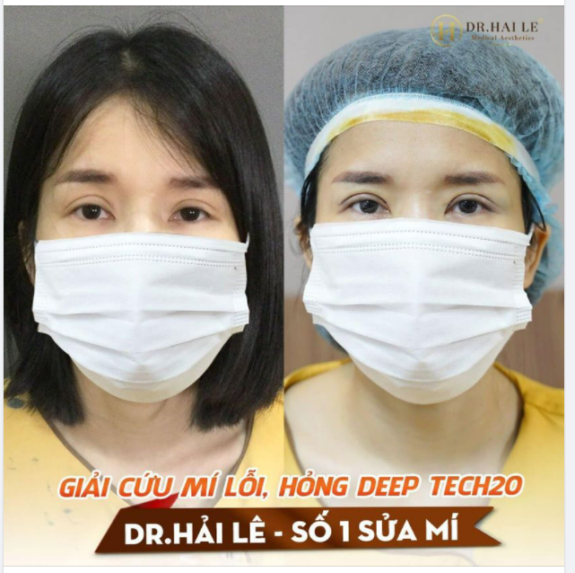GIẢI CỨU MÍ LỖI, HỎNG DEEP TECH20 - DR.HẢI LÊ SỐ 1 SỬA MÍ